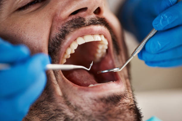 Best Emergency Tooth Extraction in Fenton, MI