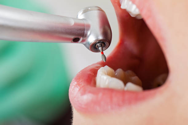 Best Emergency Tooth Extraction in Fenton, MI